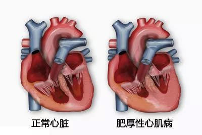 正常心脏和患肥厚性心肌病心脏的区别,图片来源  [2]